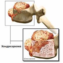 Опухоли позвоночника