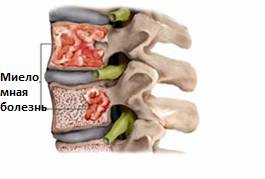 Новообразования в позвоночнике виды причины диагностика и лечение