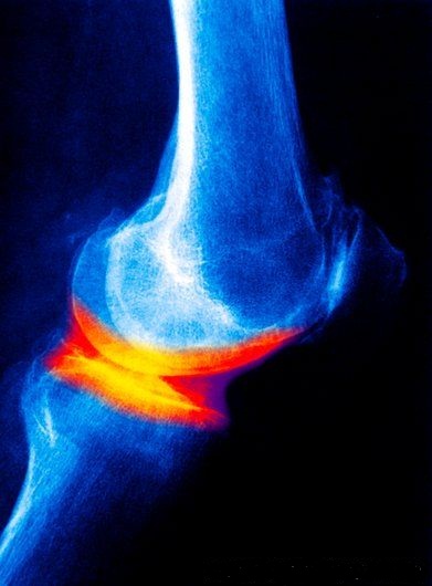 artroza deformantă a articulației talusului navicular