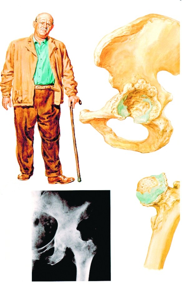 artroza deformantă a articulației talusului navicular)