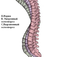 Причины остеопороза