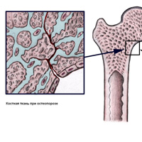 Остеопороз. Лечение остеопороза