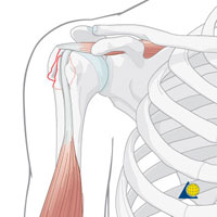 Перелом большой бугристости плечевой кости