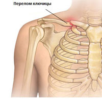 Перелом ключицы