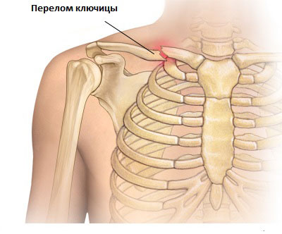 Сломано ребро: что делать?