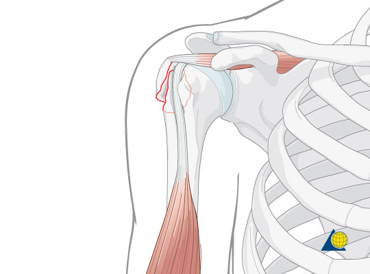 Перелом большой бугристости плечевой кости