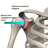 Перелом суставной впадины лопатки