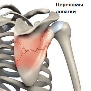 Ушиб грудной клетки