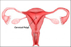 Полип шейки матки