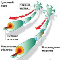 Рассеянный склероз