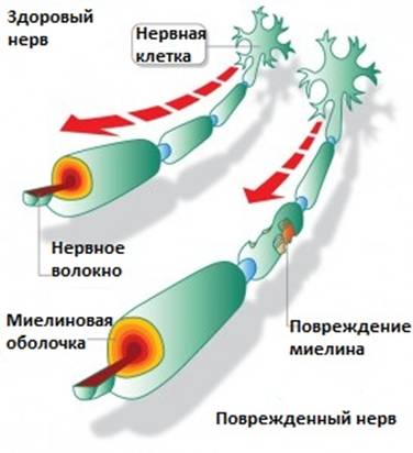 Доклад по теме Рассеянный склероз