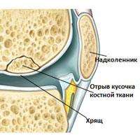 Рассекающий остеохондрит