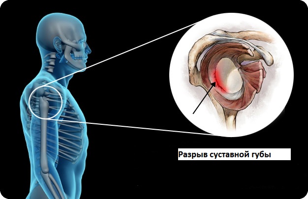 Разрыв губы гленоида. Фиброзно-хрящевая губа гленоида. Верхний сегмент суставной губы плечевого сустава. Повреждение суставной губы гленоида. Фиброзно хрящевая губа гленоида лопатки.