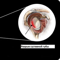 Разрыв суставной губы