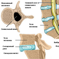 Что такое грыжа ретролистез thumbnail