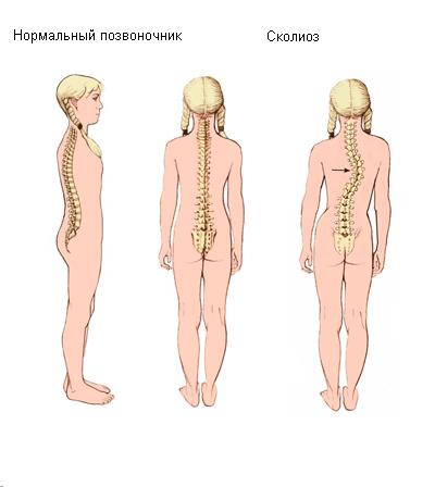 Заболевания позвоночника у детей симптомы диагностика и лечение