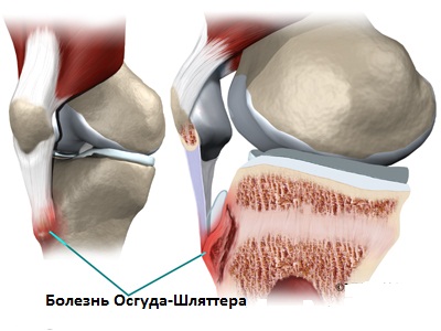 Лечение разрыва мениска коленного сустава.