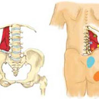 Синдром квадратной мышцы поясницы