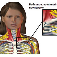 Синдром лестничной мышцы