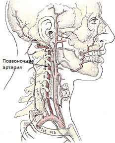 Синдром позвоночной артерии