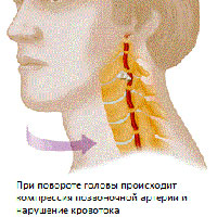 Ишемические нарушения мозга при синдроме позвоночной артерии симптомы thumbnail
