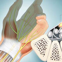 Синдром запястного канала (карпальный туннельный синдром)