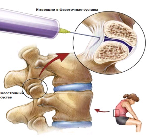 Синдром фасеточных суставов