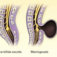 Спина бифида (расщепление позвоночника)