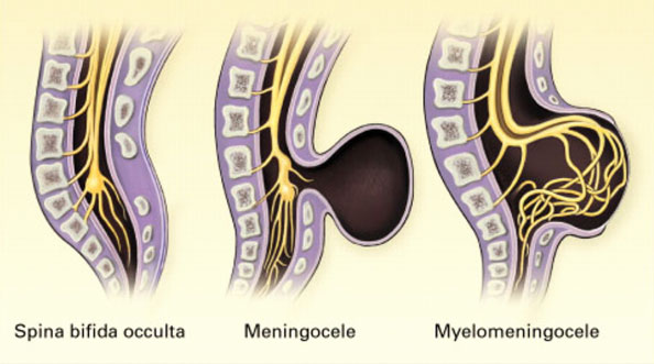 Spina bifida (расщепление позвоночника)