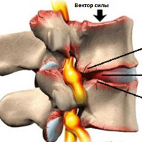 Как лечить спондилез пояснично крестцового отдела позвоночника?