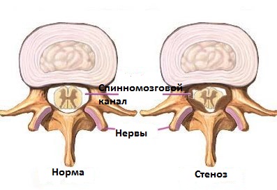 Спинальный стеноз