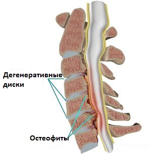 Спинальный стеноз