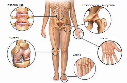 Почему болят суставы и кости: причины и лечение | Название сайта
