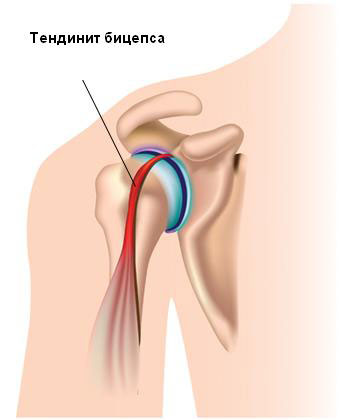 Тендинит бицепса