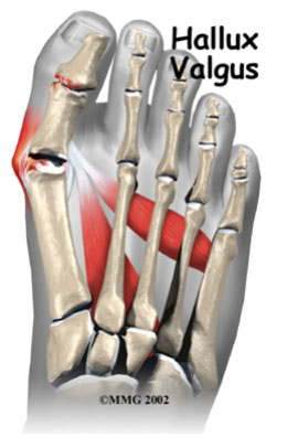 Вальгусная деформация большого пальца стопы