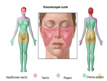 Системная красная волчанка (СКВ)