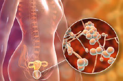 Молочница (вагинальный кандидоз)